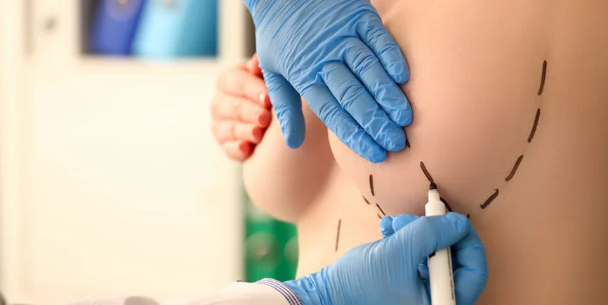 Mastektomi Cerrahi Teknikleri